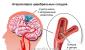 Лечение дисциркуляторной энцефалопатии