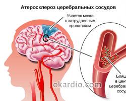 Лечение дисциркуляторной энцефалопатии